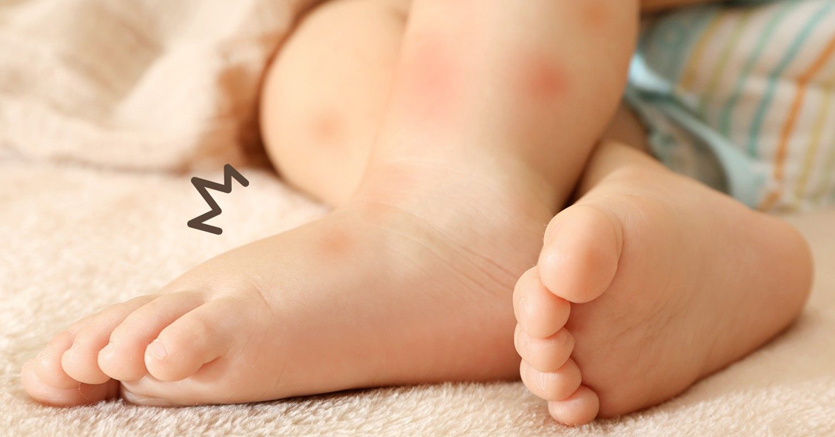Cara Menghilangkan Bekas Gigitan Nyamuk Pada Bayi, Mudah dan Cepat